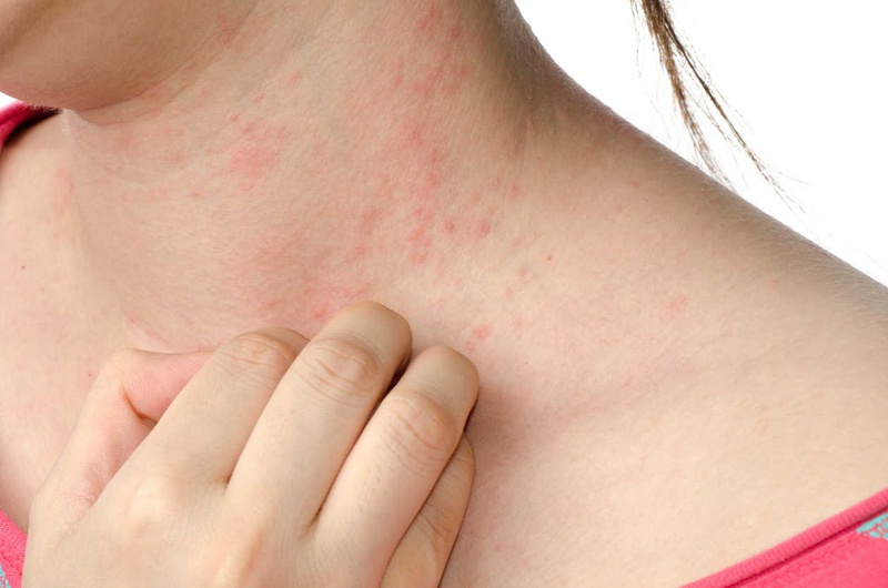 Thắc mắc: Hắc lào có nguy hiểm không, có rát không 3