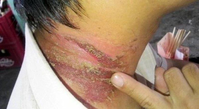 Thắc mắc: Kiến ba khoang đốt có để lại sẹo không?