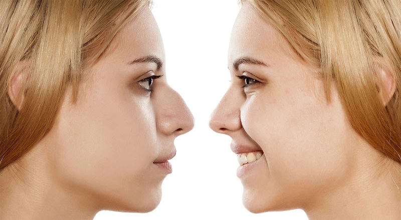 Thắc mắc: Nâng mũi ăn chuối được không?4