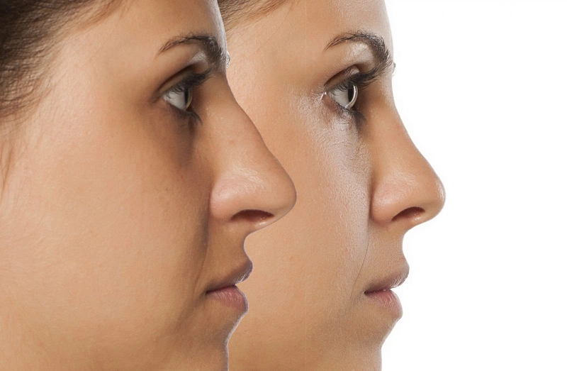 Thắc mắc: Nâng mũi ăn nấm được không?3