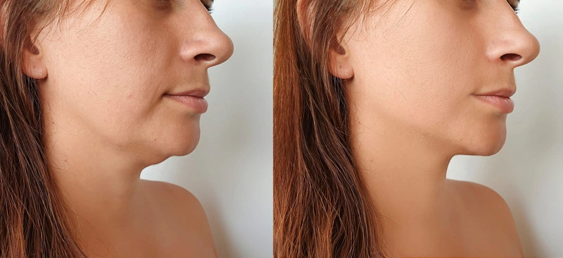 Thắc mắc: Nên độn cằm hay tiêm filler?3