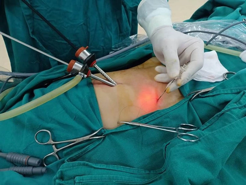 thắc mắc sau khi mổ sỏi mật xong nên kiêng ăn gì 1