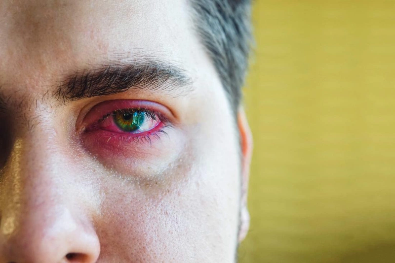 Thắc mắc: Tại sao đeo lens bị cay mắt?1