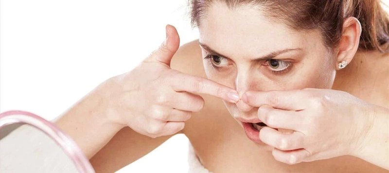 Thắc mắc: Tiêm filler mũi có được nặn mụn không?1