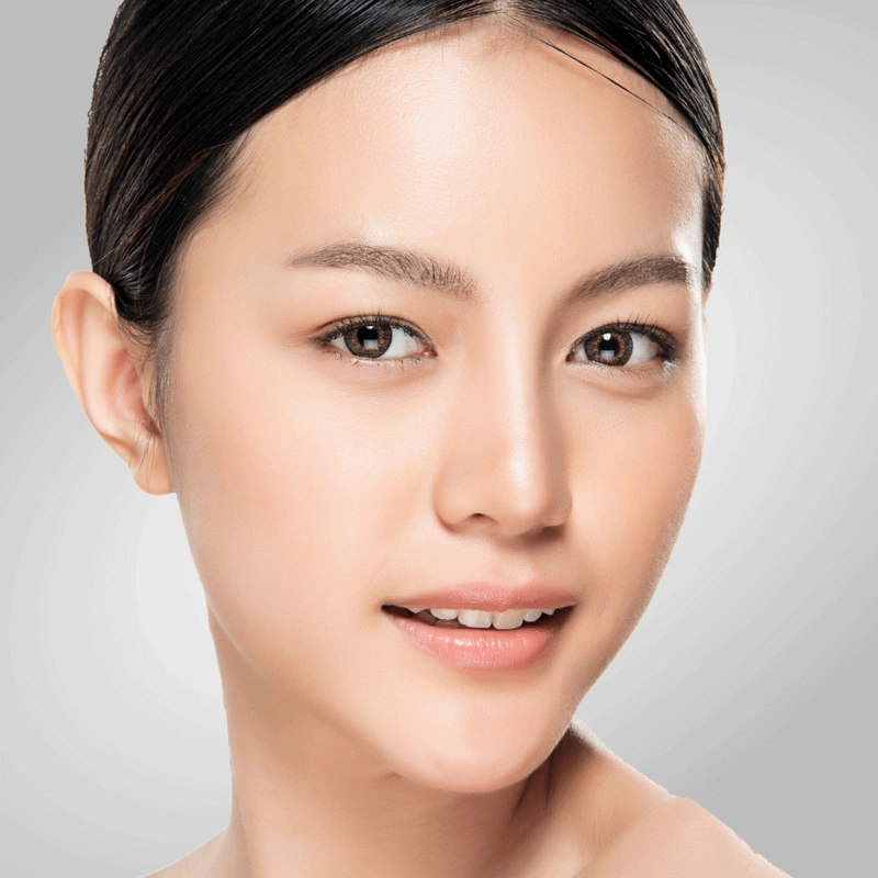 Thắc mắc: Tiêm filler mũi có được nặn mụn không?3