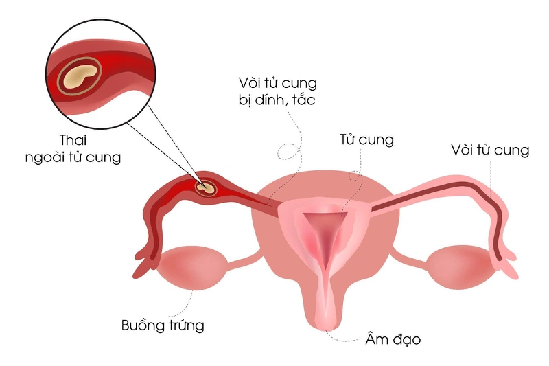 Thai ngoài tử cung có sinh được không và cách điều trị 1