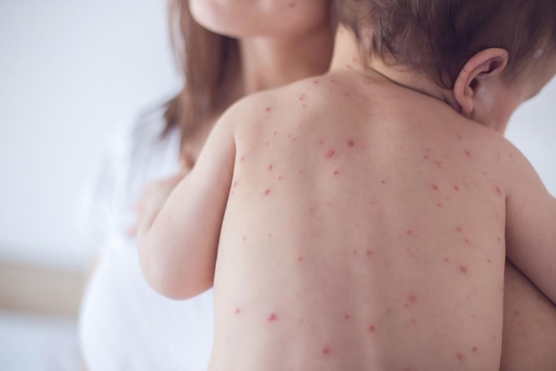 [THAM KHẢO] Chi phí tiêm sởi quai bị rubella bao nhiêu tiền? 1
