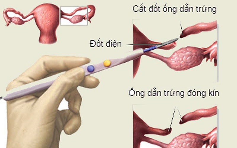 Thắt ống dẫn trứng có tháo được hay không? 2