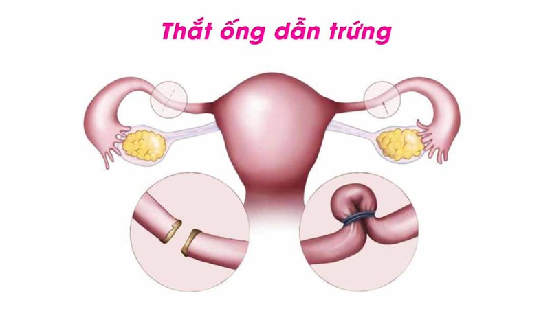 Thắt ống dẫn trứng có tháo được hay không? 1