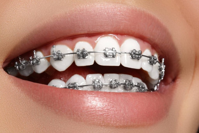 Thế nào là khớp cắn chuẩn? Làm thế nào để có hàm răng chuẩn khớp cắn? 3