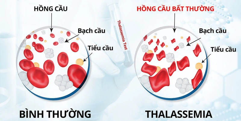 Thiếu máu hồng cầu nhỏ khi mang thai ảnh hưởng như thế nào đến thai nhi? 2