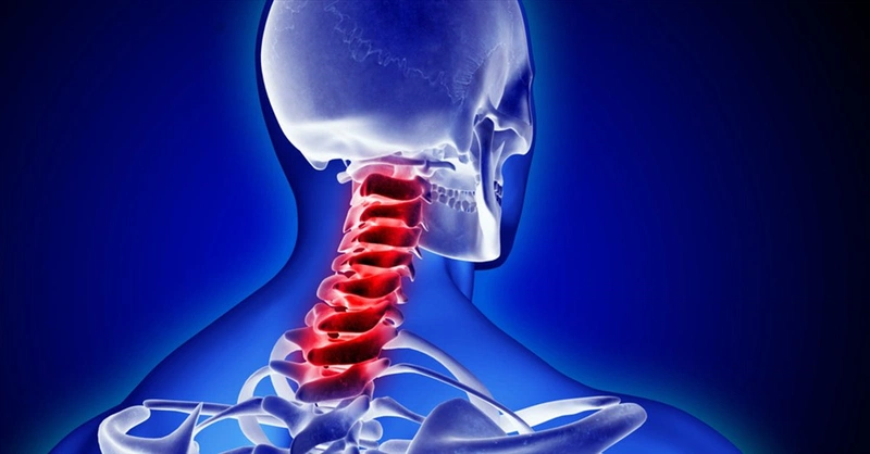Thoái hóa cột sống cổ biến chứng nguy hiểm bạn cần biết1