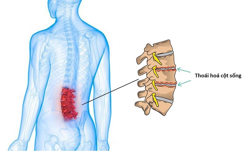 Người thoái hóa cột sống thắt lưng nên ăn gì? 1