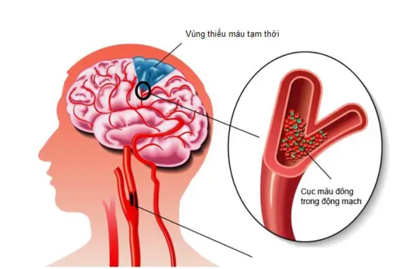 Hậu quả không ngờ của thoái hóa đốt sống cổ gây thiếu máu não2