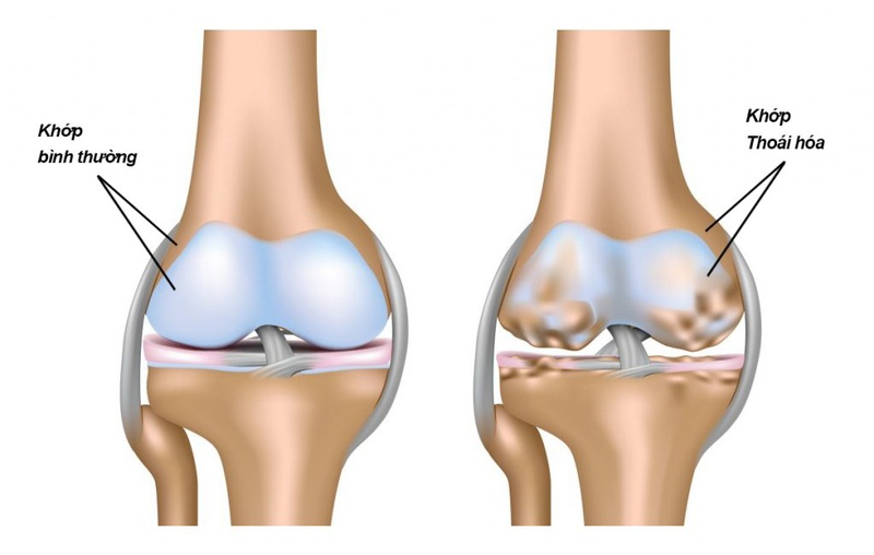 Vì sao sụn khớp dễ bị thoái hóa