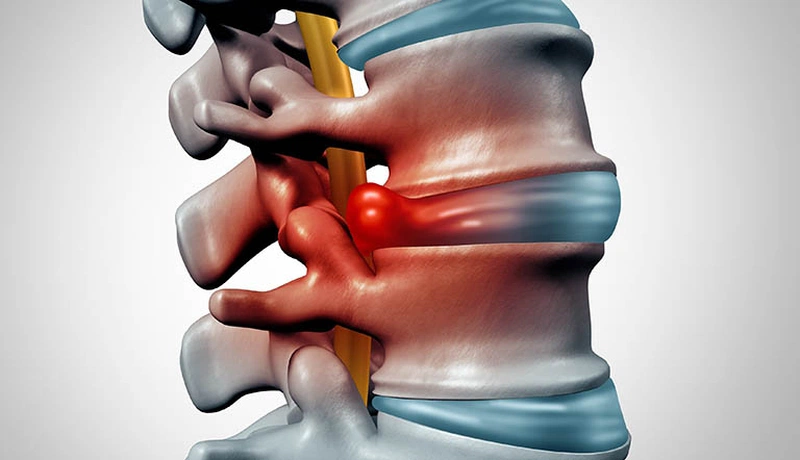 Thoát vị đĩa đệm có chữa được không? Chữa như thế nào? 1