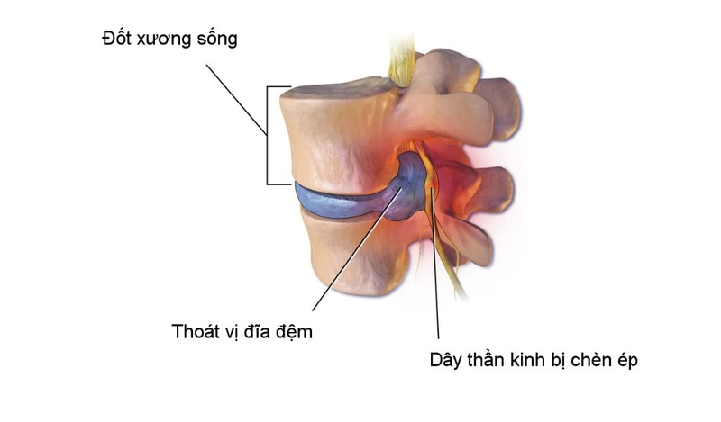 Thoát vị đĩa đệm cột sống cổ do dâu? Có cách chữa trị triệt để không? 2