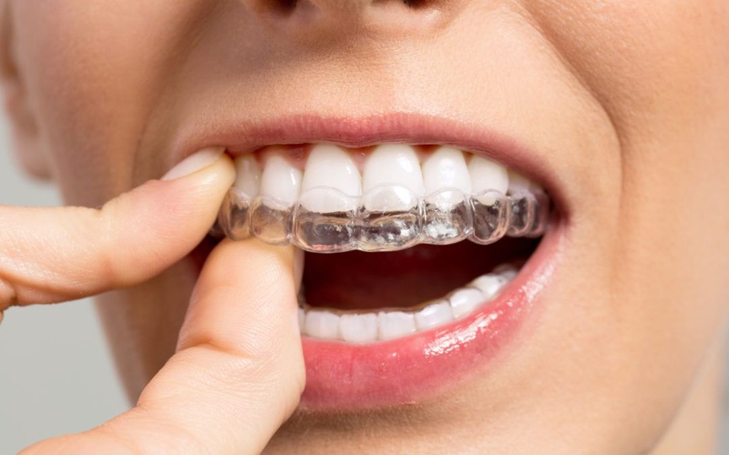 Thời điểm lý tưởng để niềng răng cho trẻ 3