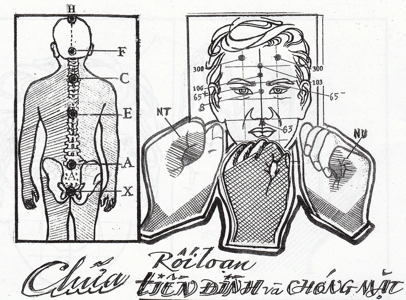 Thông tin chữa rối loạn tiền đình bằng diện chẩn2