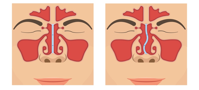 Hỏi đáp: Thu nhỏ đầu mũi có vĩnh viễn không 2