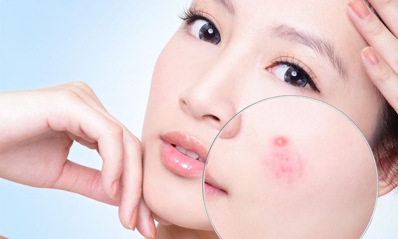 Những thực phẩm gây hại cho da mà bạn đang dùng mỗi ngày