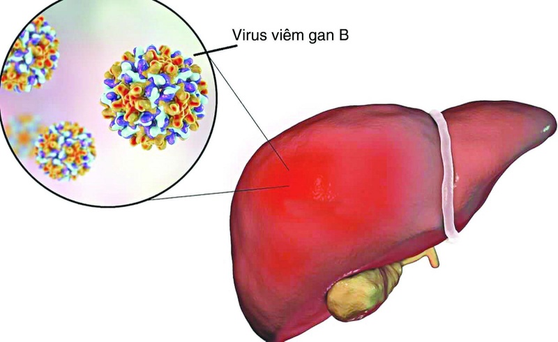 Thuốc điều trị viêm gan B có đặc điểm gì? Các loại thuốc viêm gan B phổ biến 1