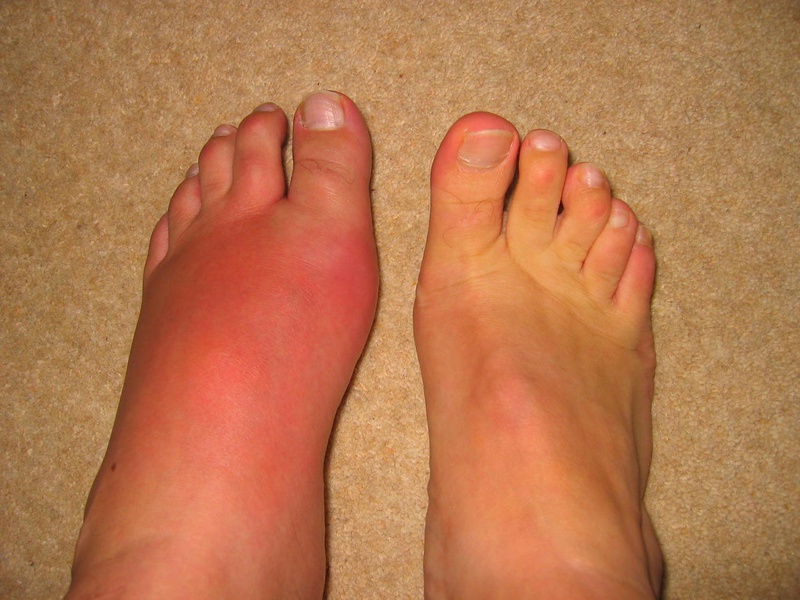Thuốc mới điều trị bệnh gout - Cách chữa gout hiệu quả 1