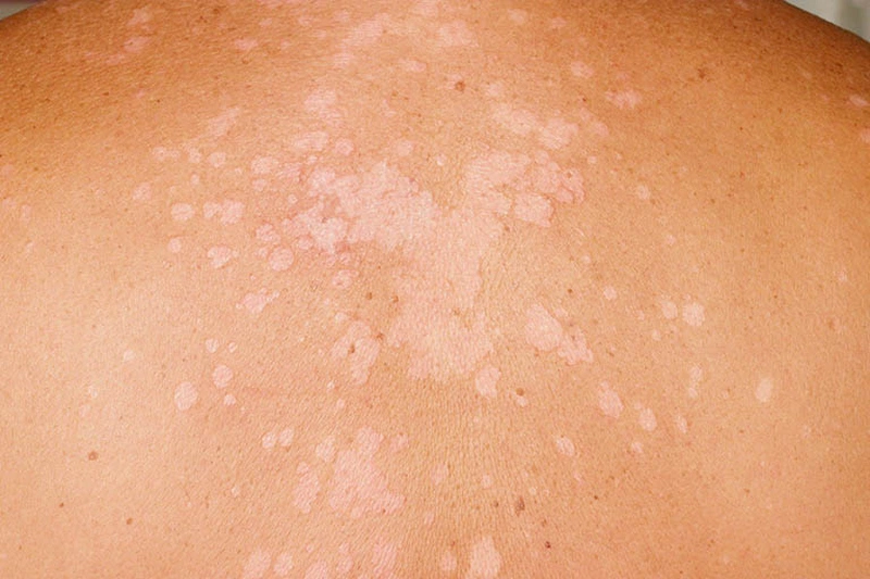 Vùng lưng thường bị bỏ quên, không được vệ sinh kỹ nên bệnh dễ lây lan nhanh