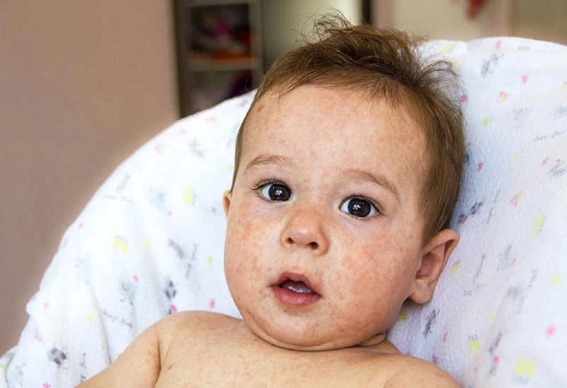 Lang beng ở trẻ em là một bệnh lý ngoài da do nấm Malassezia gây ra