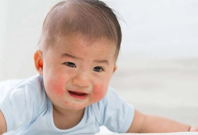 7 loại thuốc trị mẩn ngứa cho bé tốt nhất hiện nay
