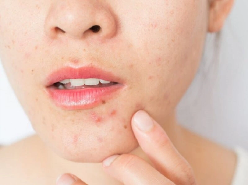 Bật mí những loại kem trị mụn bọc tốt nhất trên thị trường hiện nay 1