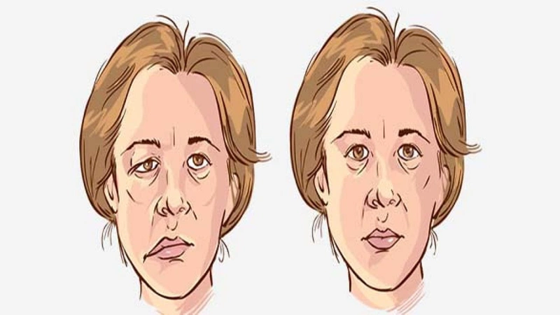 Nhưng lưu ý khi điều trị liệt dây thần kinh số 7 