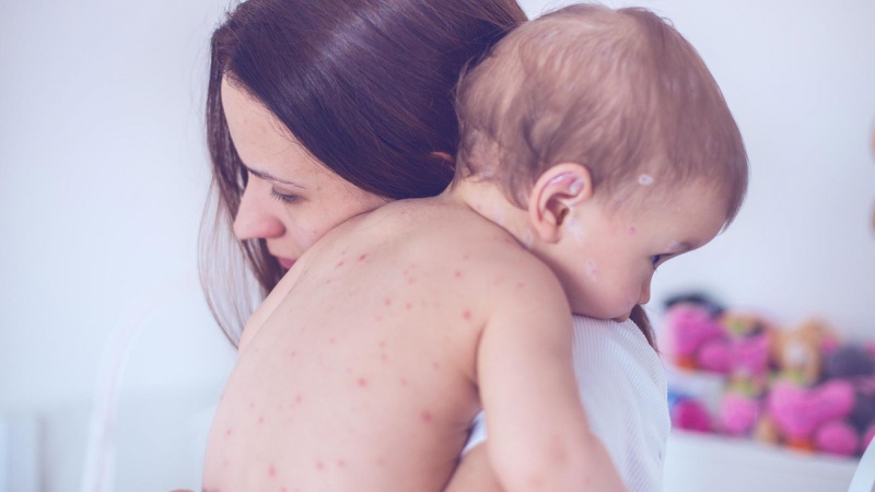 Thủy đậu biểu hiện như thế nào và một số lưu ý khi điều trị 2