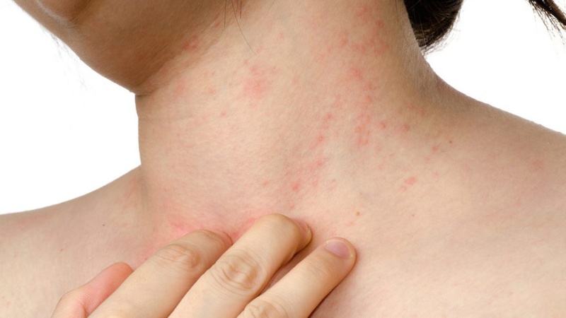 Thủy đậu dễ lây khi nào?