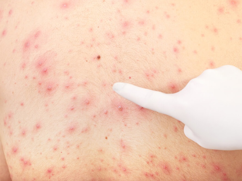 Thủy đậu gây đau đầu nguy hiểm như thế nào 1