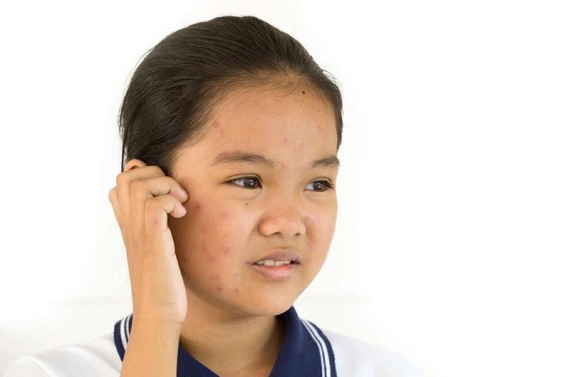 Thủy đậu kéo dài mấy ngày? 2