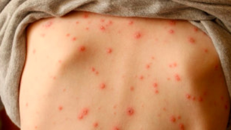 Thủy đậu không sốt có khả năng gây nguy hiểm không 2