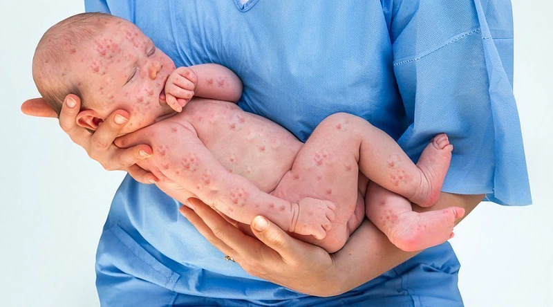 Thủy đậu trong thai kỳ và nguy cơ thủy đậu bẩm sinh 2