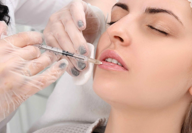 Phương pháp tiêm filler môi được nhiều người lựa chọn