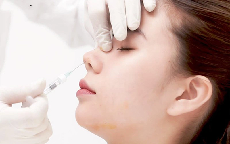 Tiêm filler xong có nâng mũi được không? 4