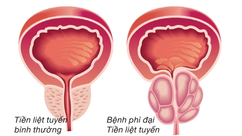 Tiểu buốt ở nam giới - Nguyên nhân và cách phòng ngừa - Hình 2