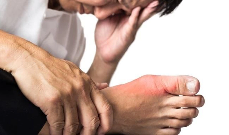 Tiêu chuẩn chẩn đoán Gout chính xác được sử dụng ngày nay