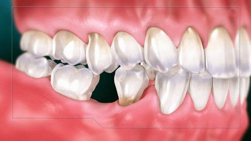 Tiêu xương răng nguy hiểm như thế nào đến sức khỏe? 1