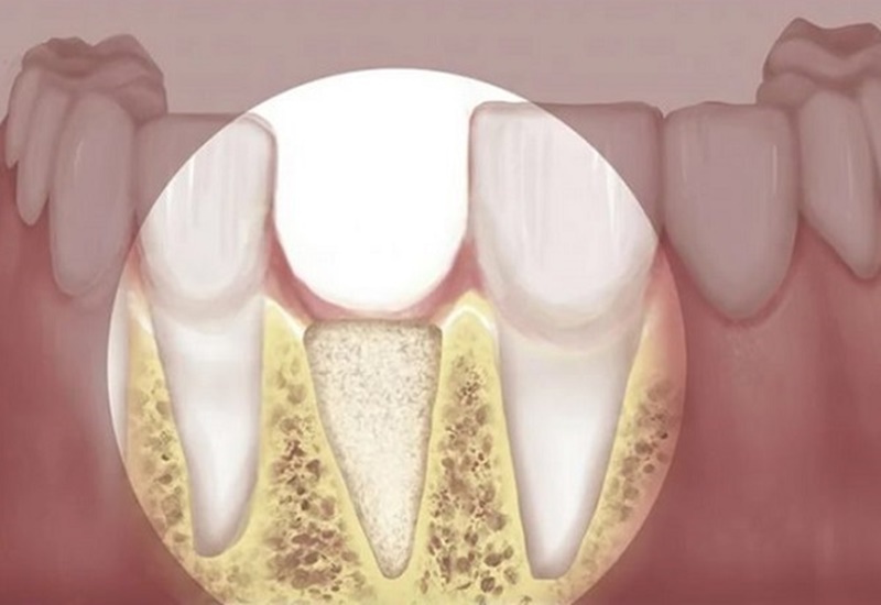 Tiêu xương răng nguy hiểm như thế nào đến sức khỏe? 2