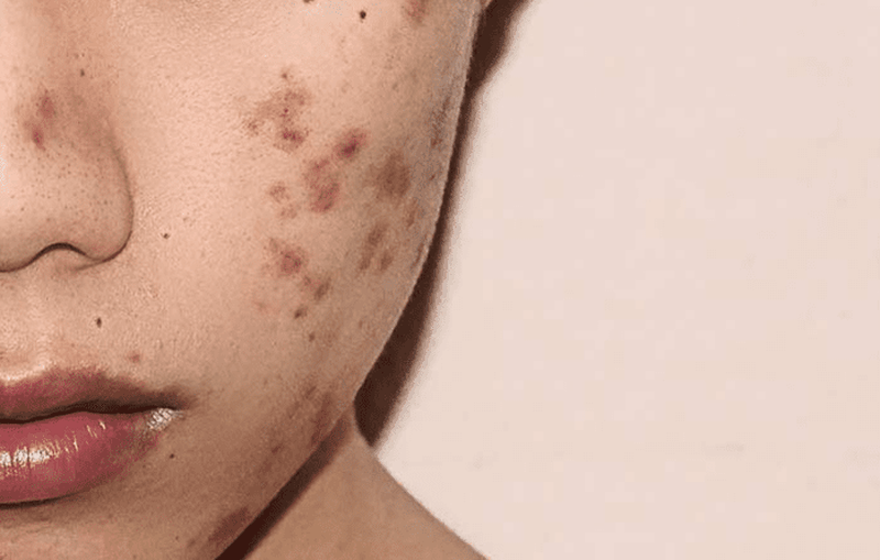 Tìm hiểu 5 cách trị thâm mụn từ tự nhiên đơn giản và hiệu quả 1