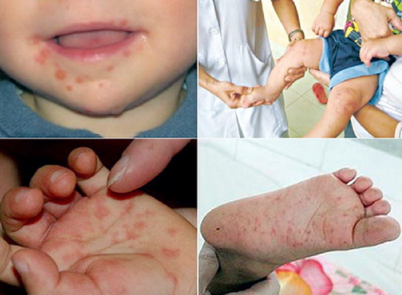 Tìm hiểu vểbệnh tay chân miệng ở trẻ em-01