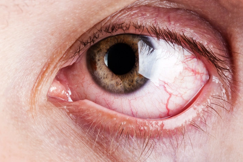 Tìm hiểu các biện pháp phòng chống bệnh đau mắt hột 2