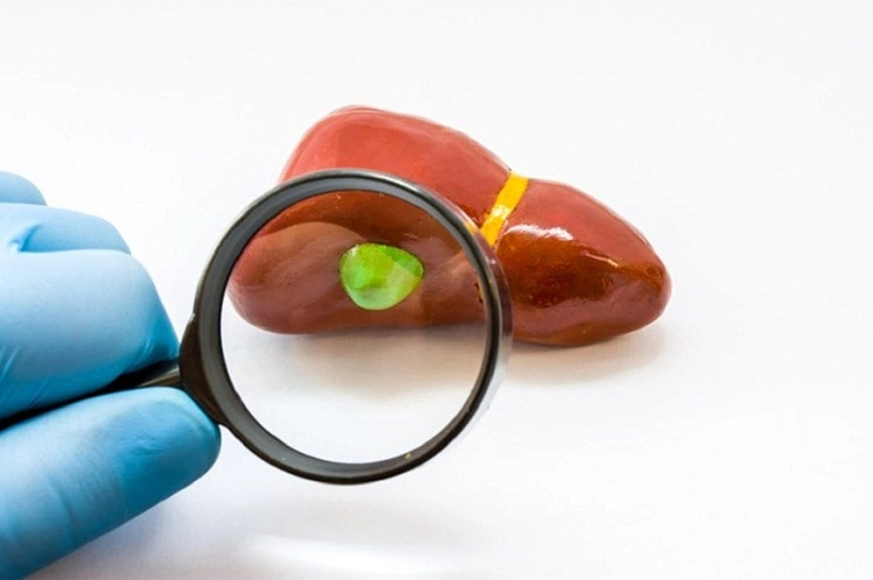 Tìm hiểu điểm tương đồng giữa sỏi mật và polyp túi mật