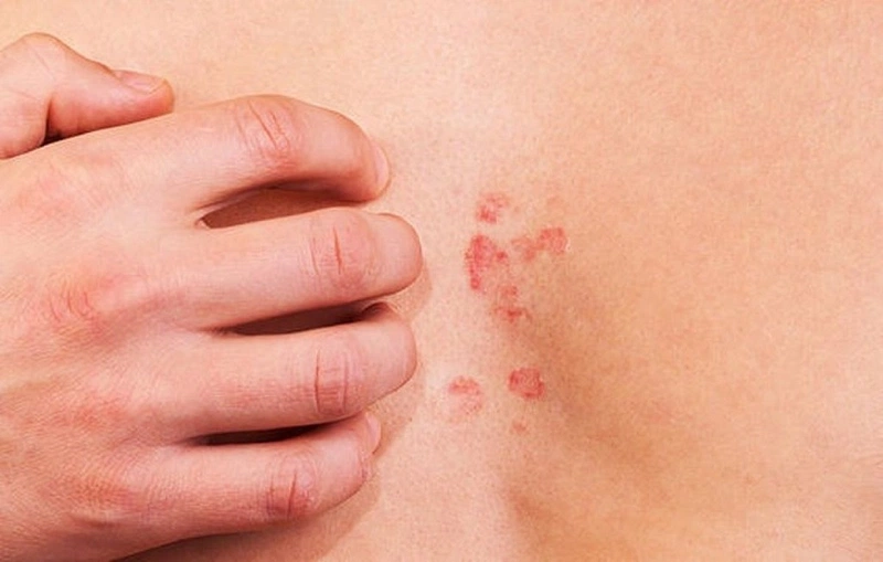 Tìm hiểu phương pháp chữa bệnh dị ứng thời tiết dứt điểm 3