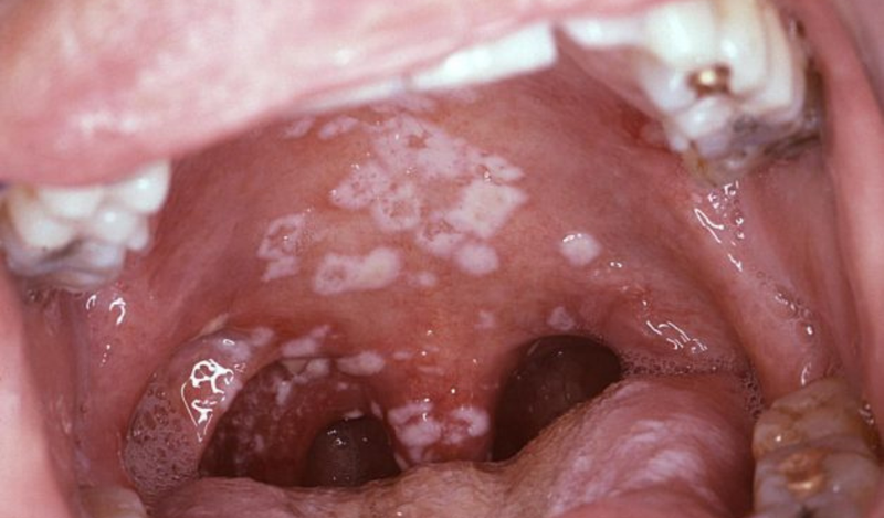 Nhớ các dấu hiệu ung thư vòm họng giai đoạn đầu cơ hội sống sót lên tới 72